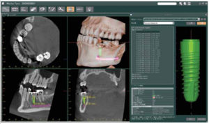 3D R100 Implant Image