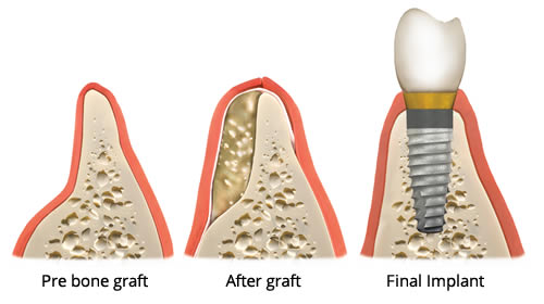 Done Grafting Diagram