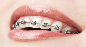 Teeth with traditional braces