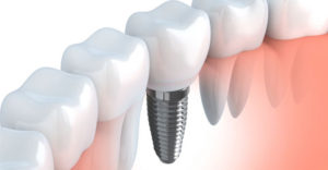 Dental Implant Illustration