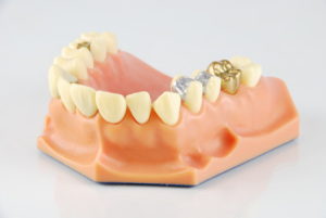 Different Types of Fillings & Bonding