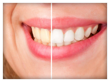 Teeth Whitening Before & After