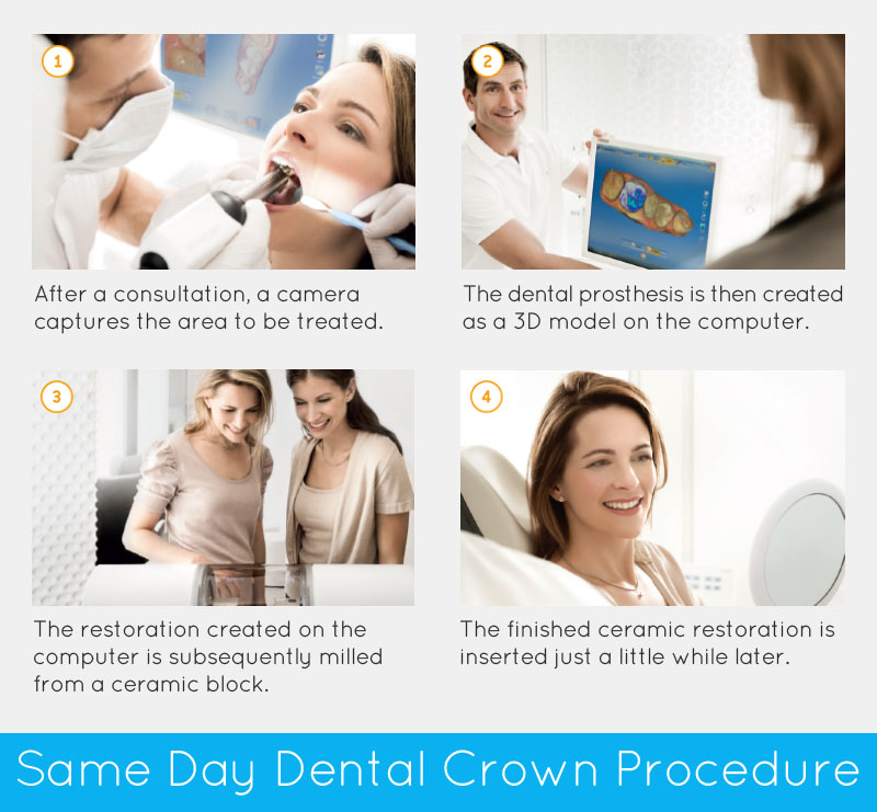 Same Day Dental Crowns Procedure