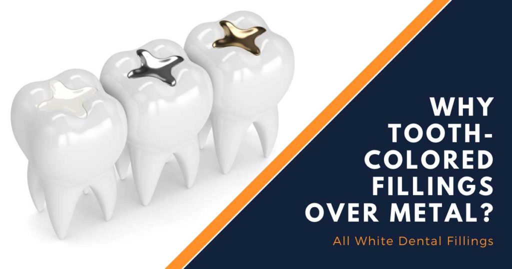 Why Tooth Colored Fillings Over Metal Fillings